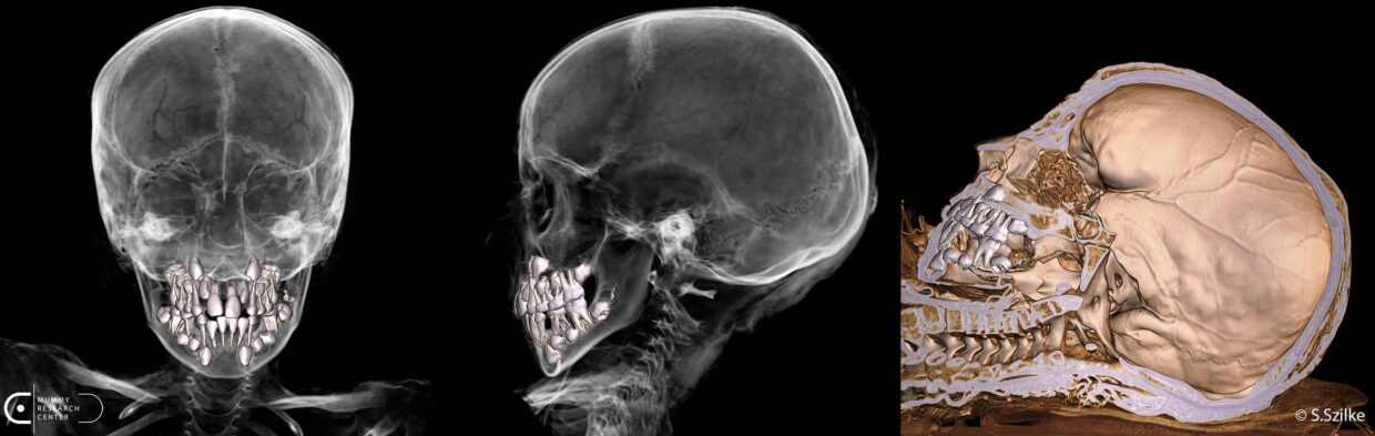 Rekonstrukcja 3D uzębienia mumii dziecka z Wrocławia.