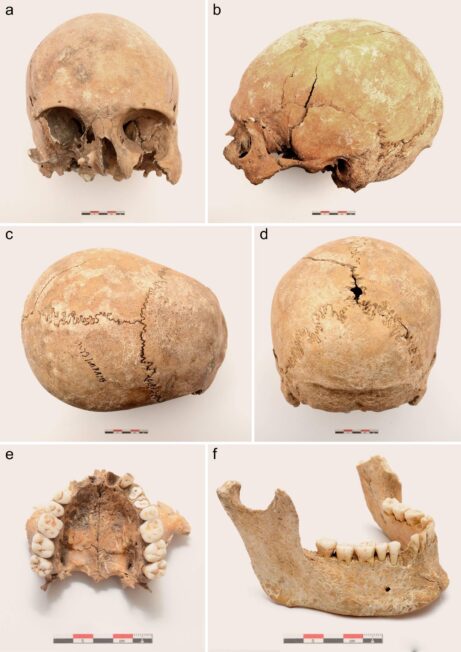 Stan zachowania czaszki dorosłego mężczyzny ze stanowiska Kleczanów 8: a – widok w normie frontalis, b – w normie lateralis sinistra, c – w normie verticalis, d – w normie occipitalis, e – widok od strony podniebienia (maxilla), f – widok boczny żuchwy (mandibula) (Fot. A. Hałuszko)